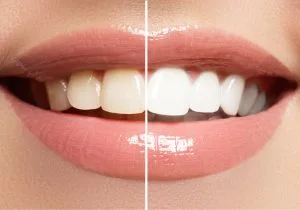 Zoom teeth whitening result at iCare in Norcross, GA